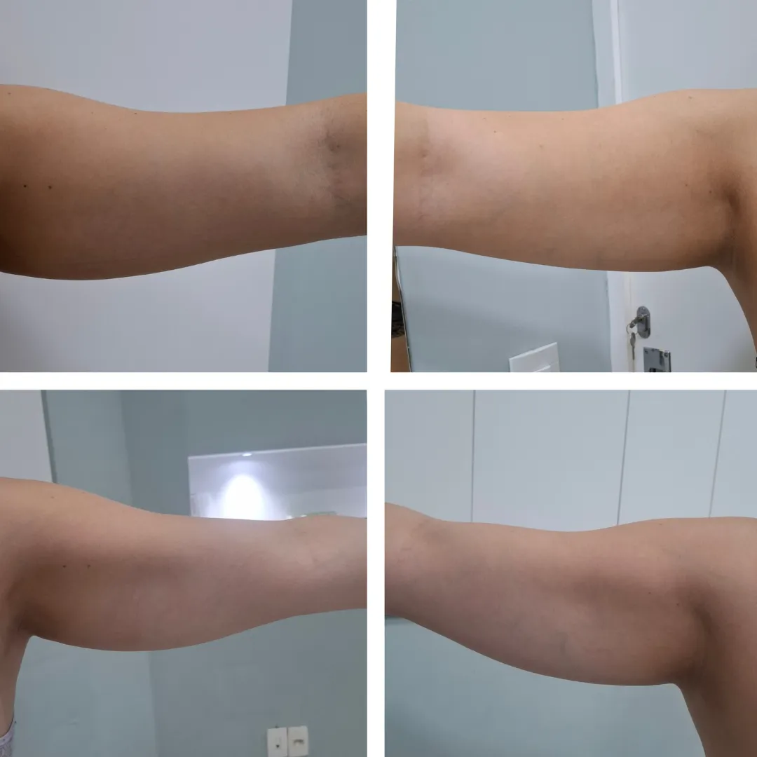 Antes e depois da criolipólise, resultado 1