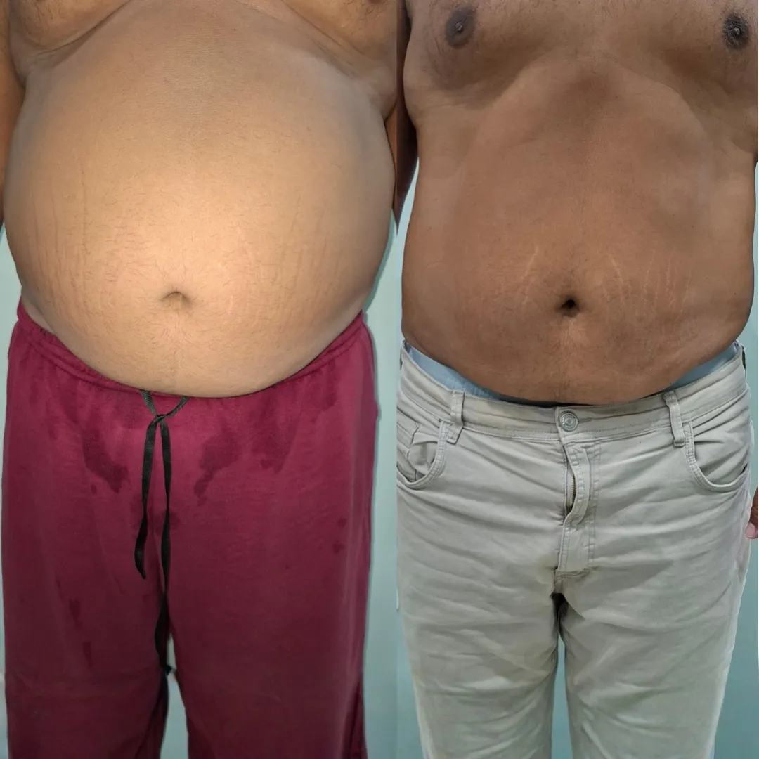 Antes e depois da criolipólise, resultado 2