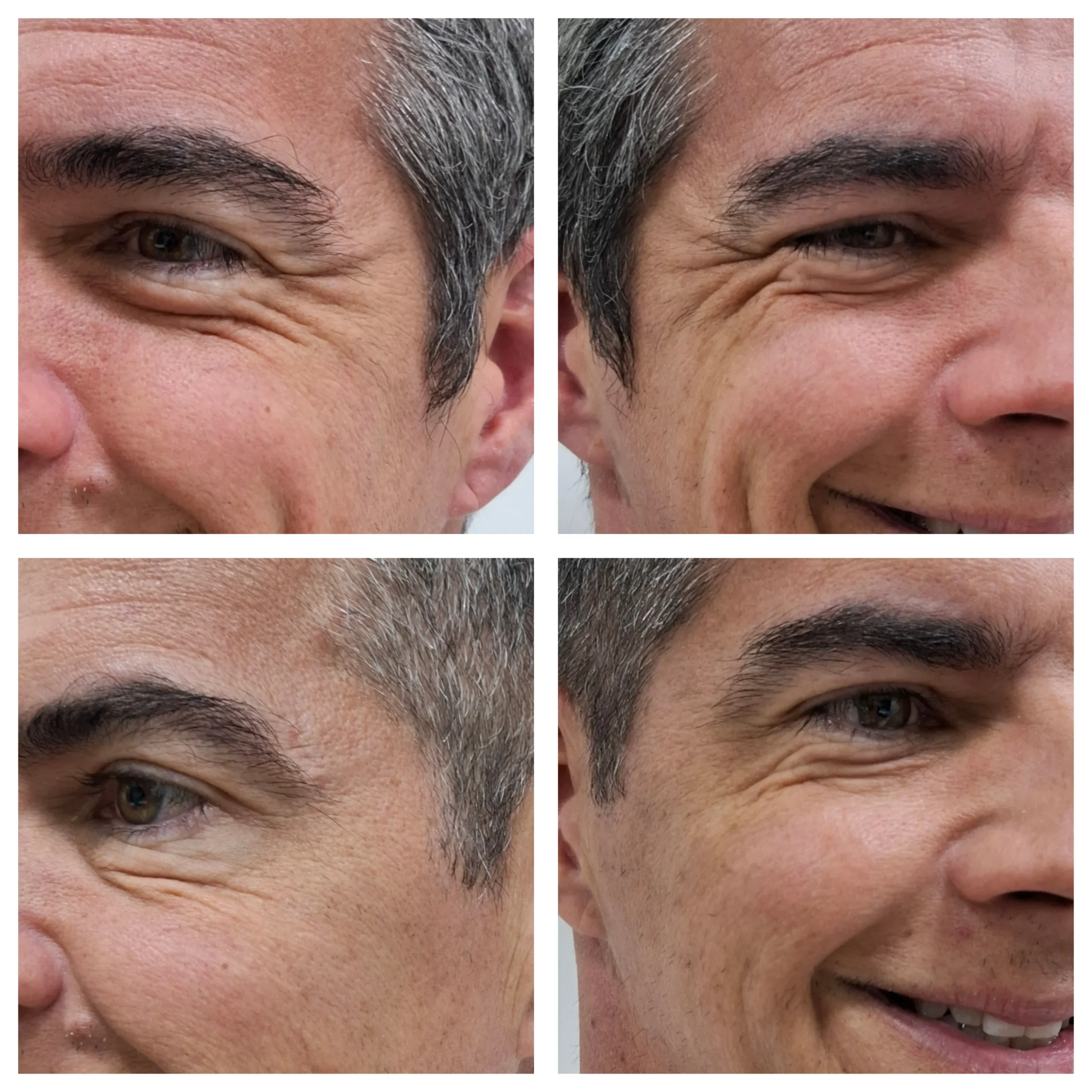Antes e depois do Botox, resultado 6