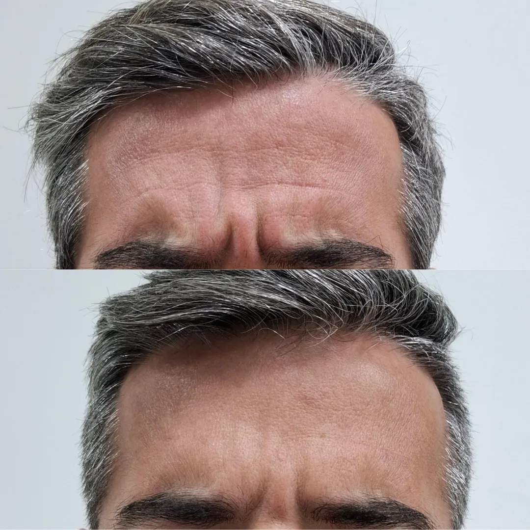 Antes e depois do Botox, resultado 1