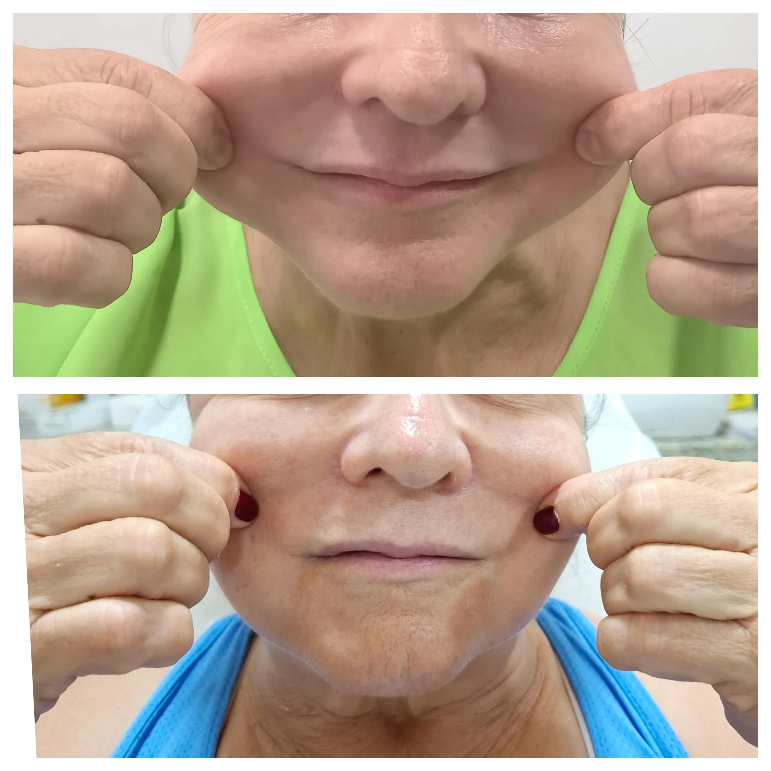Antes e depois do bioestimulador de colágeno, resultado 2