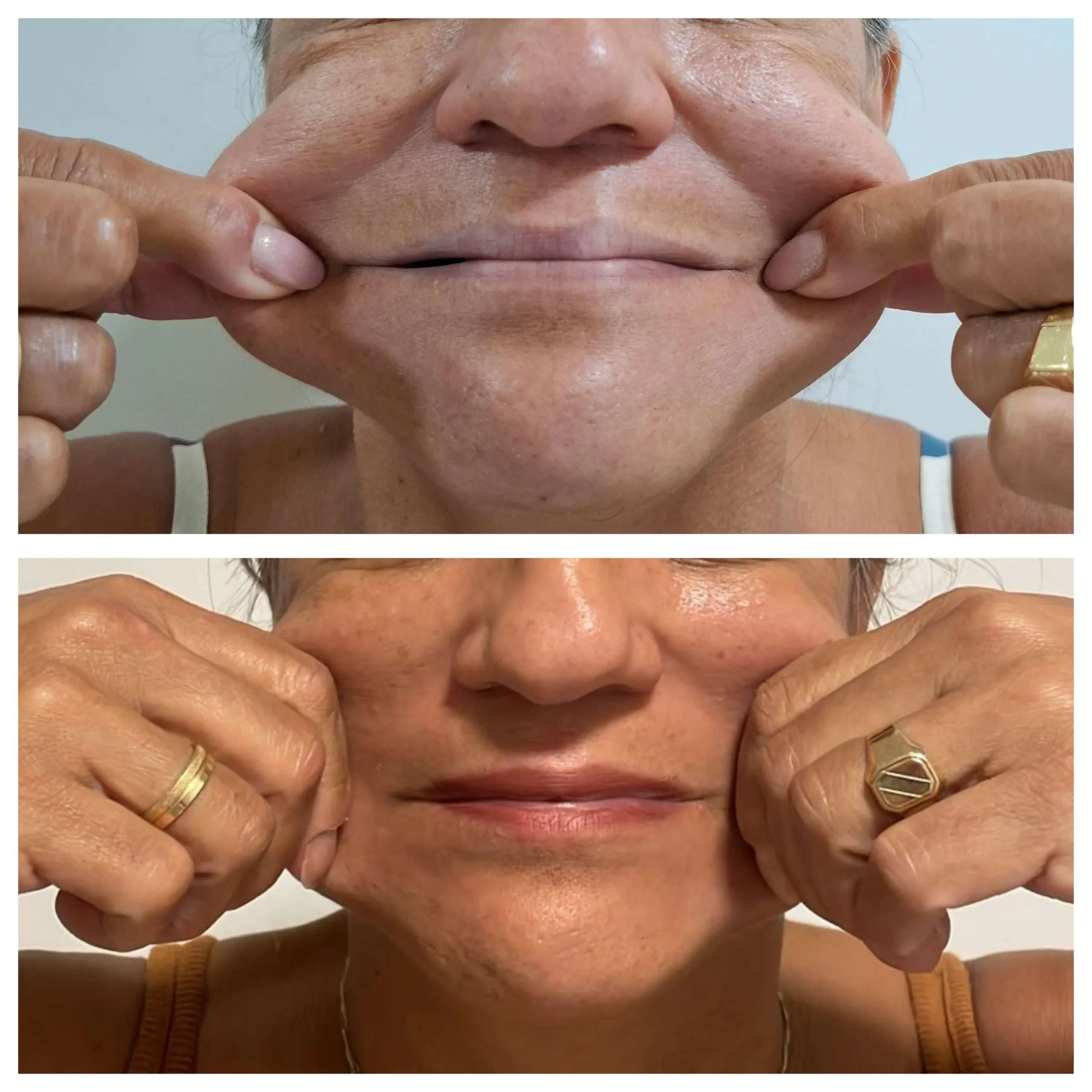Antes e depois do bioestimulador de colágeno, resultado 3