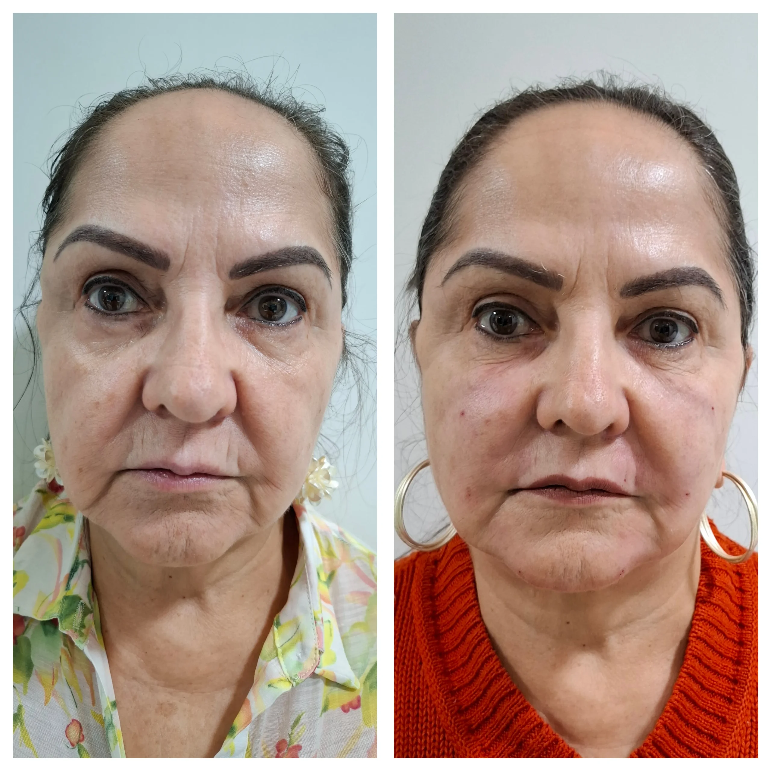Antes e depois do bioestimulador de colágeno, resultado 4