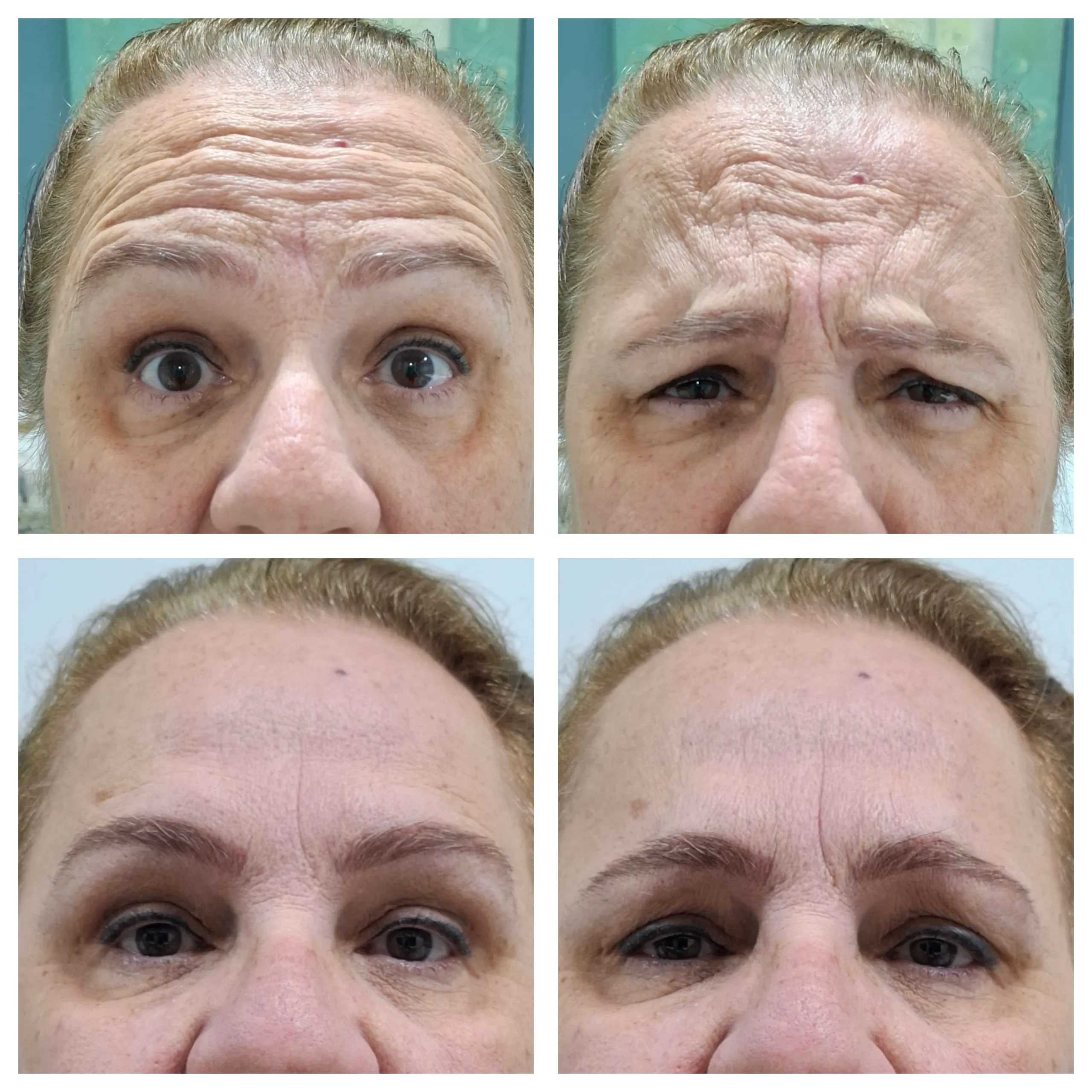 Antes e depois do Botox, resultado 2