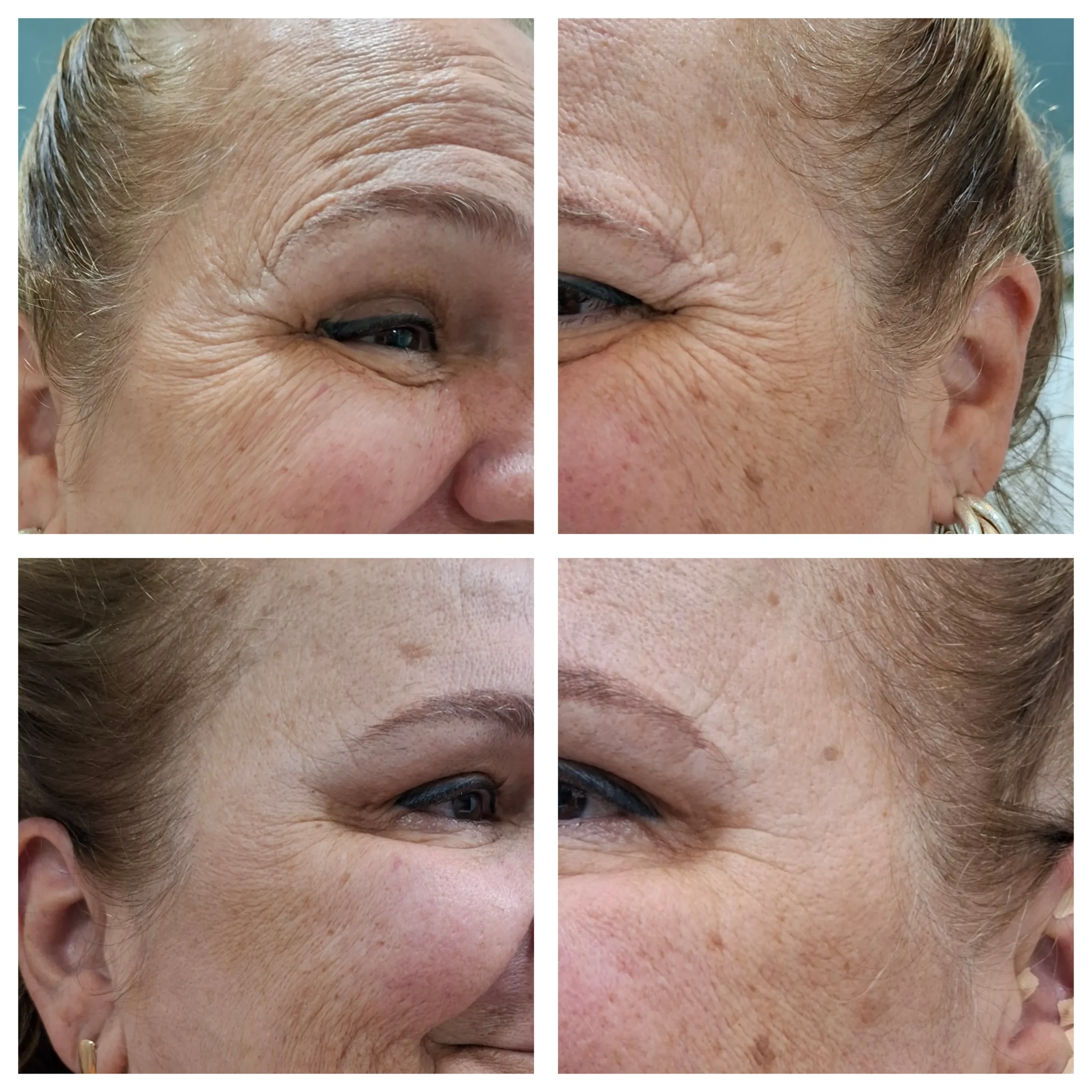 Antes e depois do Botox, resultado 3