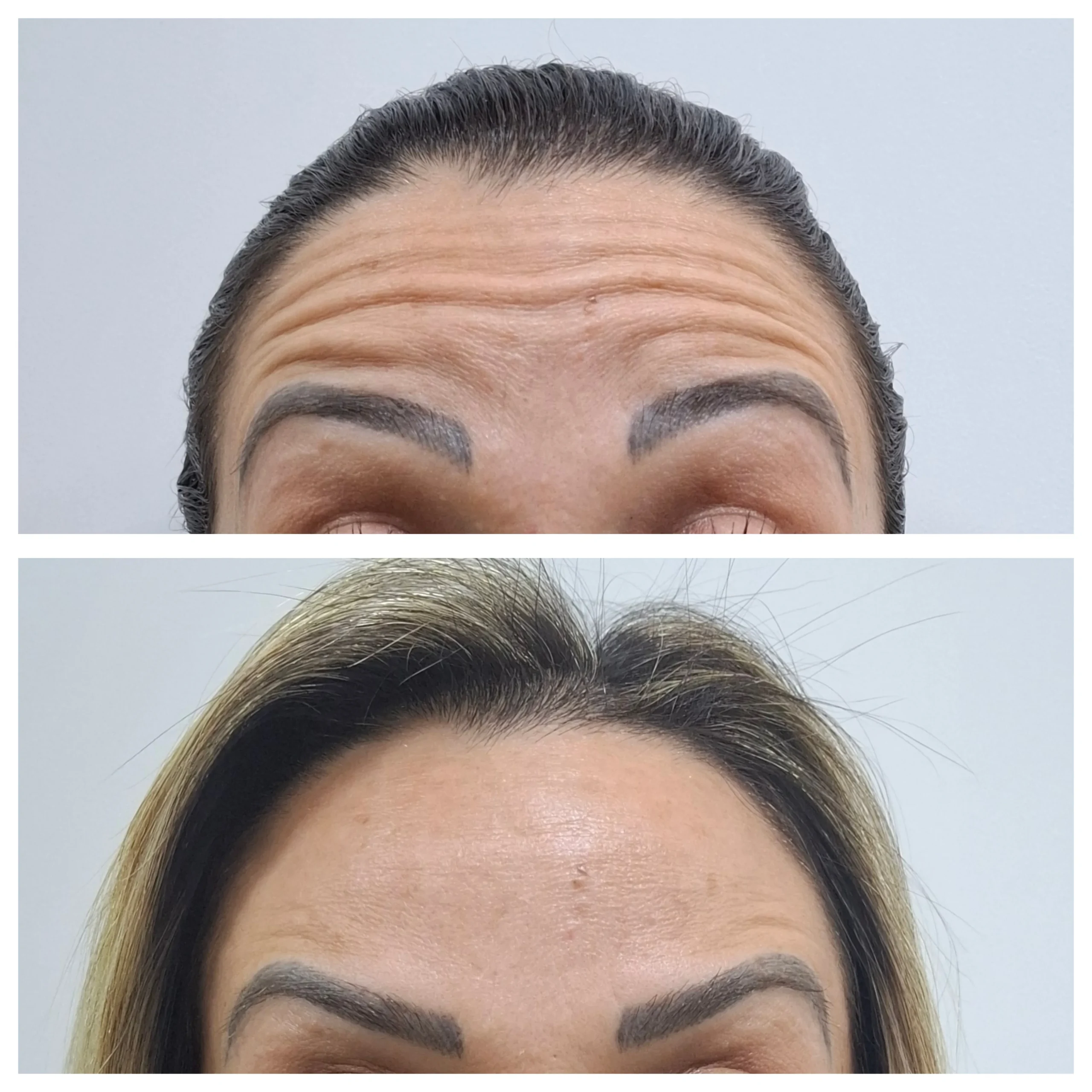 Antes e depois do Botox, resultado 4