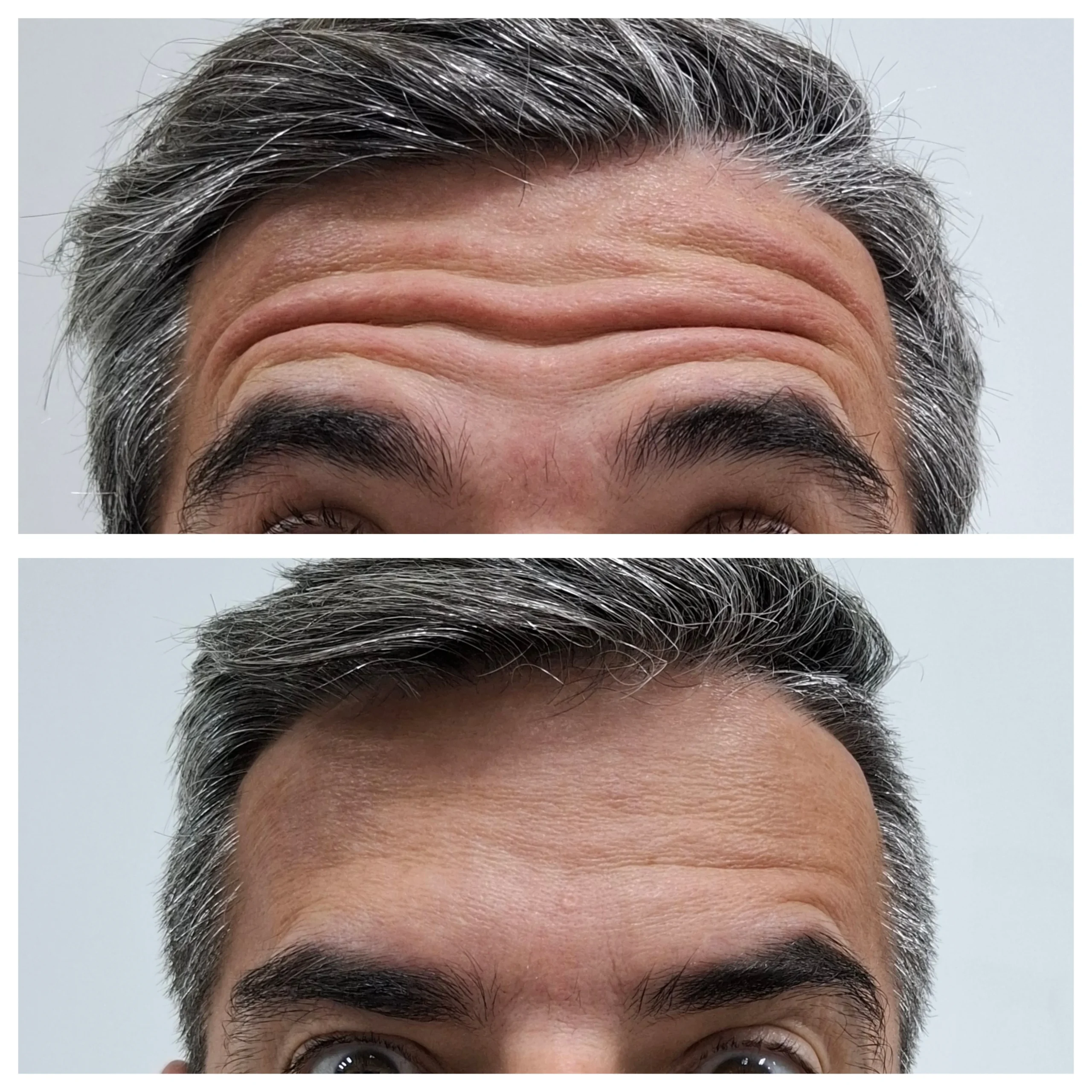 Antes e depois do Botox, resultado 5