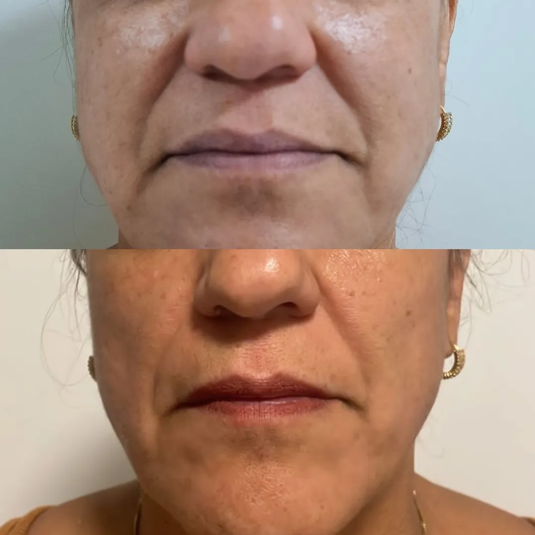 Antes e depois do bioestimulador de colágeno, resultado 1