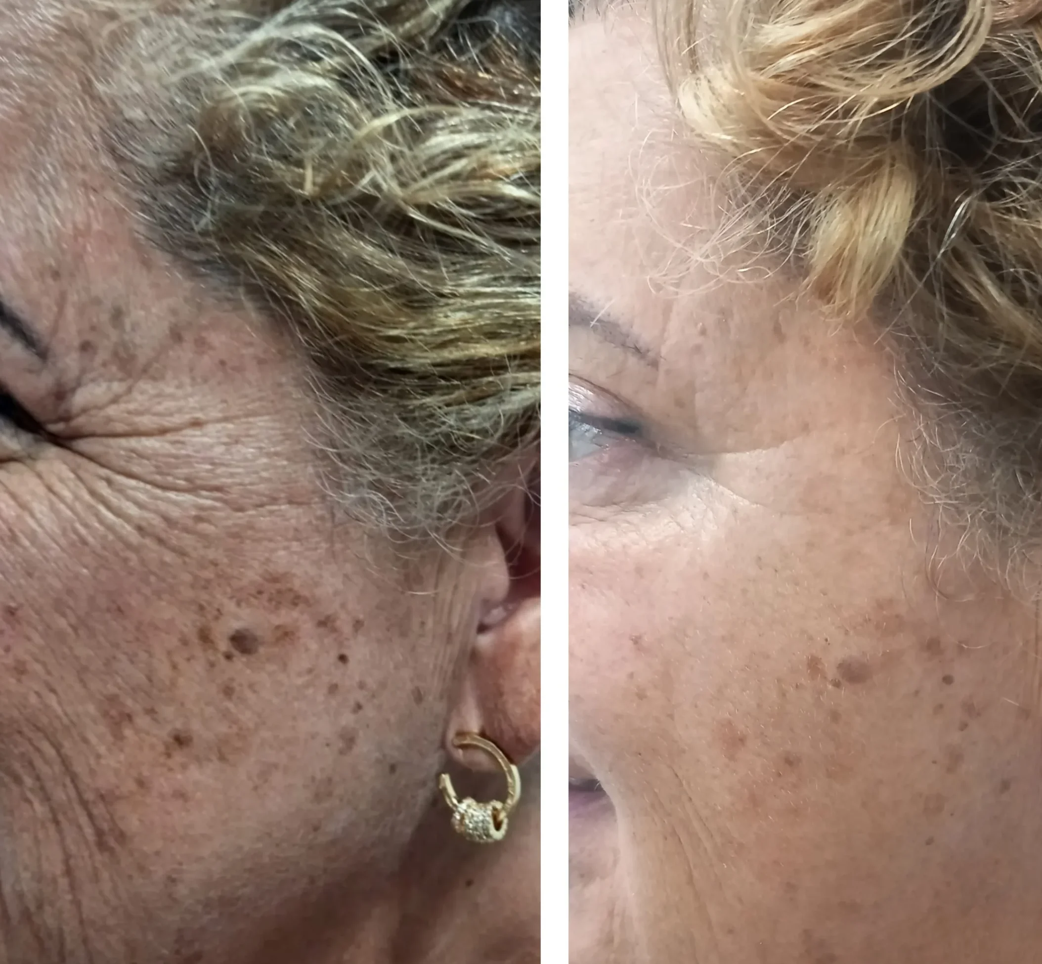 Antes e depois do clareamento de manchas