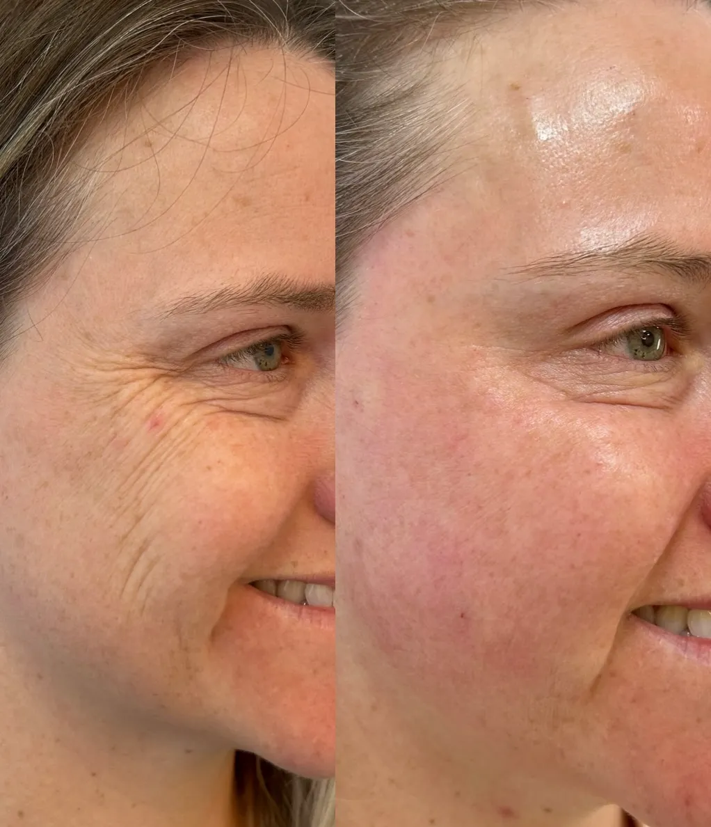 Antes e depois do protocolo New Skin, resultado 12