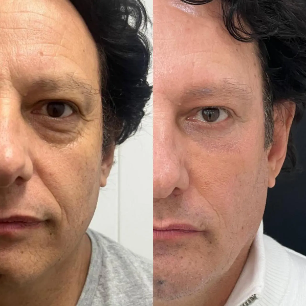 Antes e depois do protocolo New Skin, resultado 13