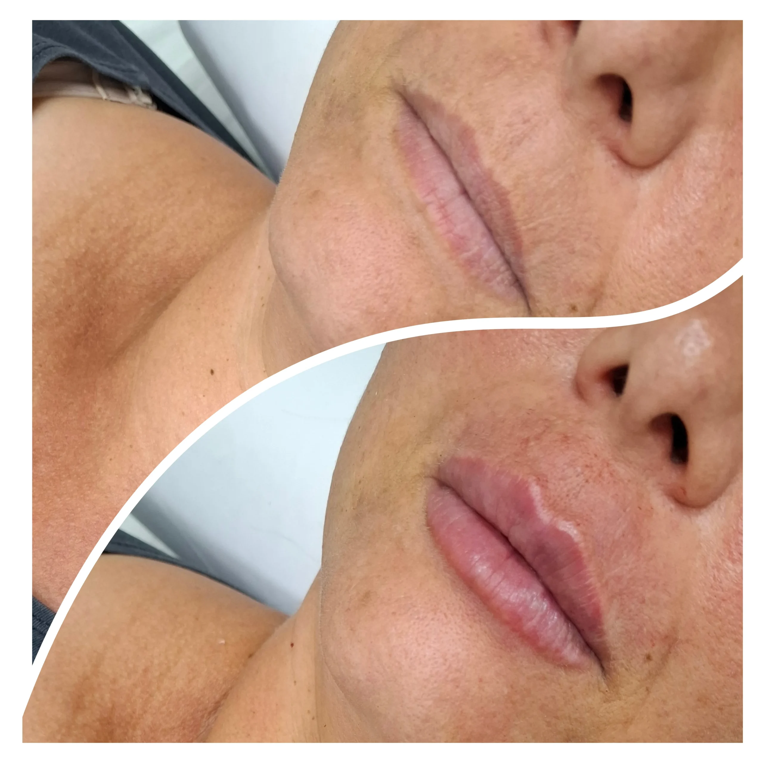 Antes e depois de preenchimento labial, resultado 1