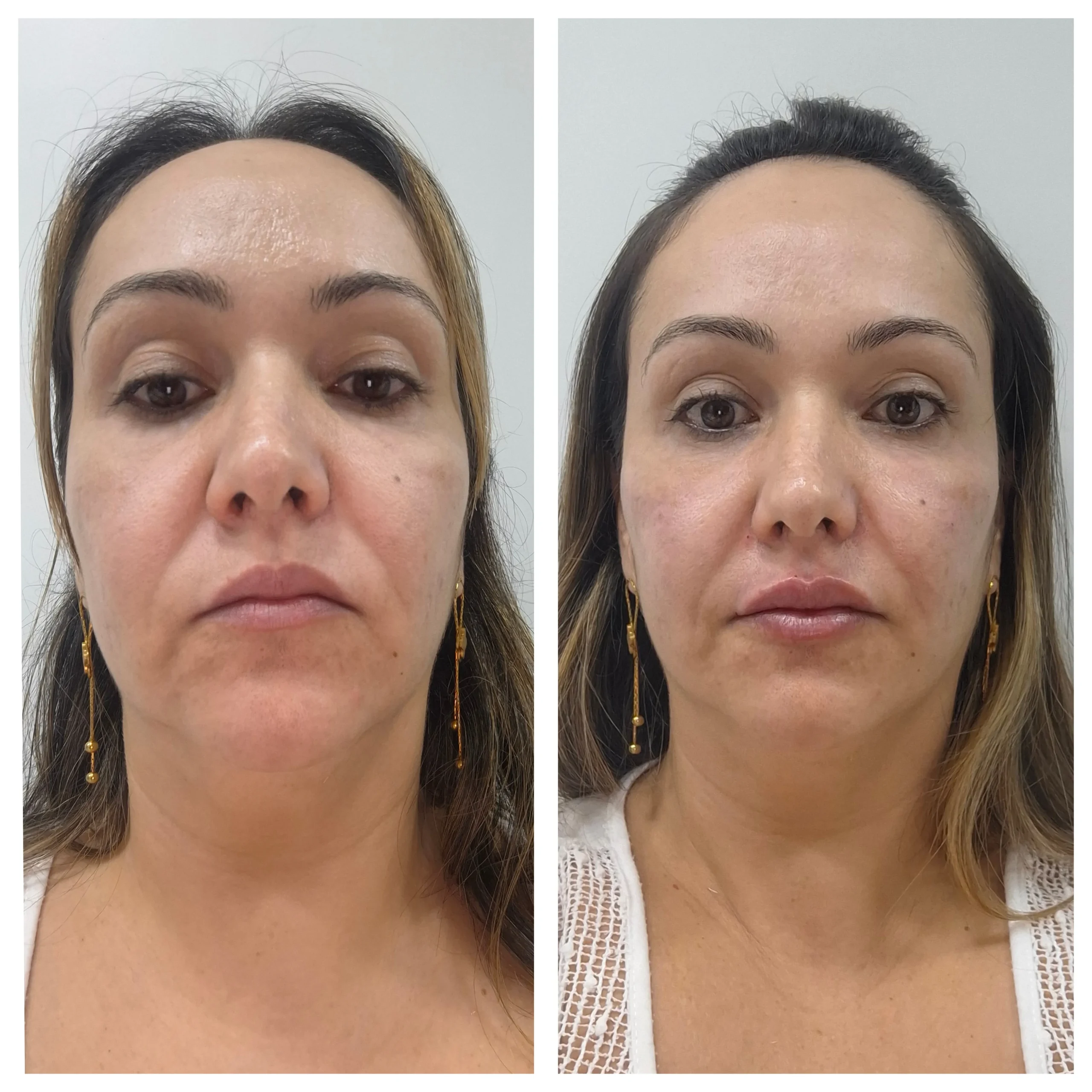 Antes e depois de preenchimento labial, resultado 2