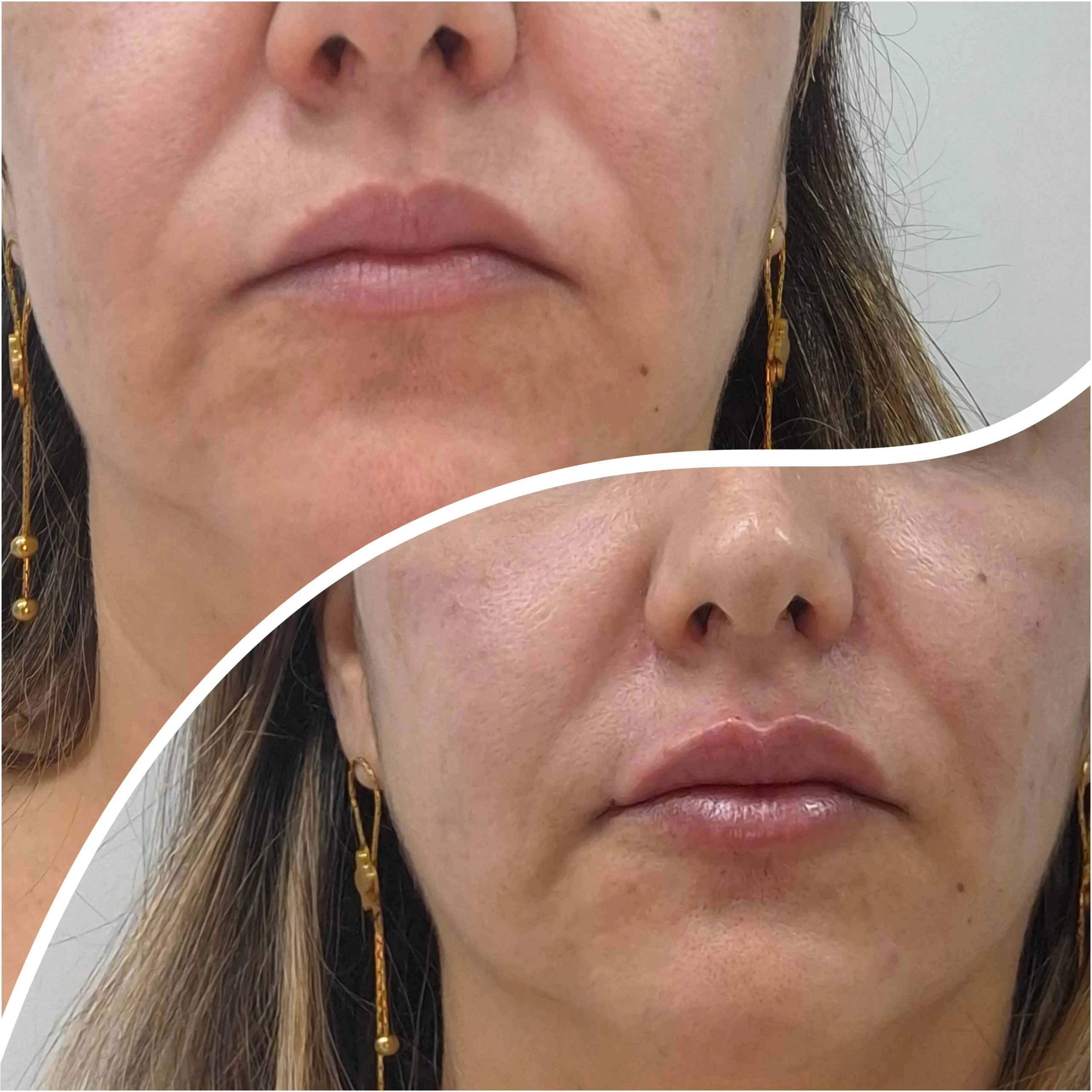 Antes e depois de preenchimento labial, resultado 3