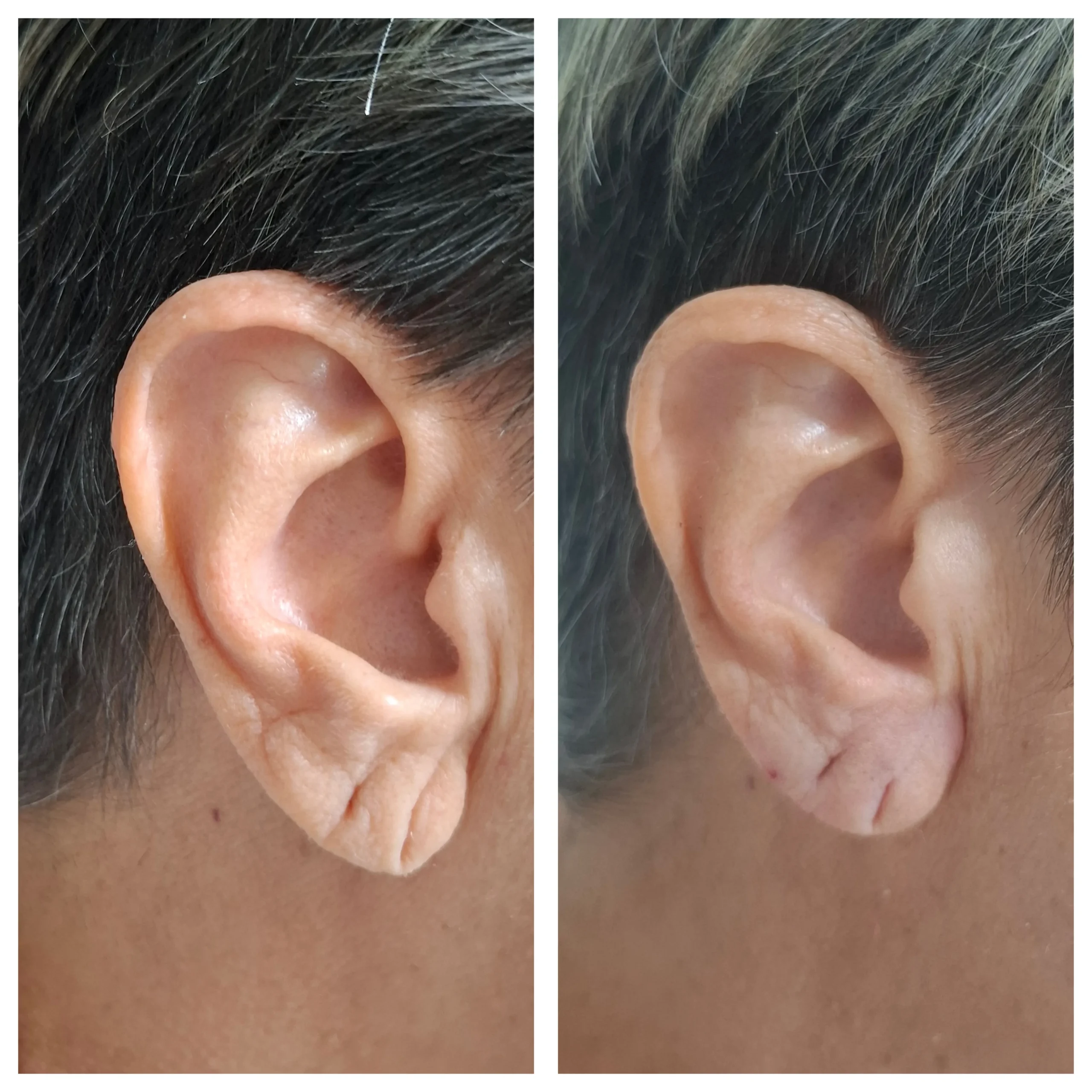 Antes e depois de preenchimento do lóbulo da orelha, resultado 1