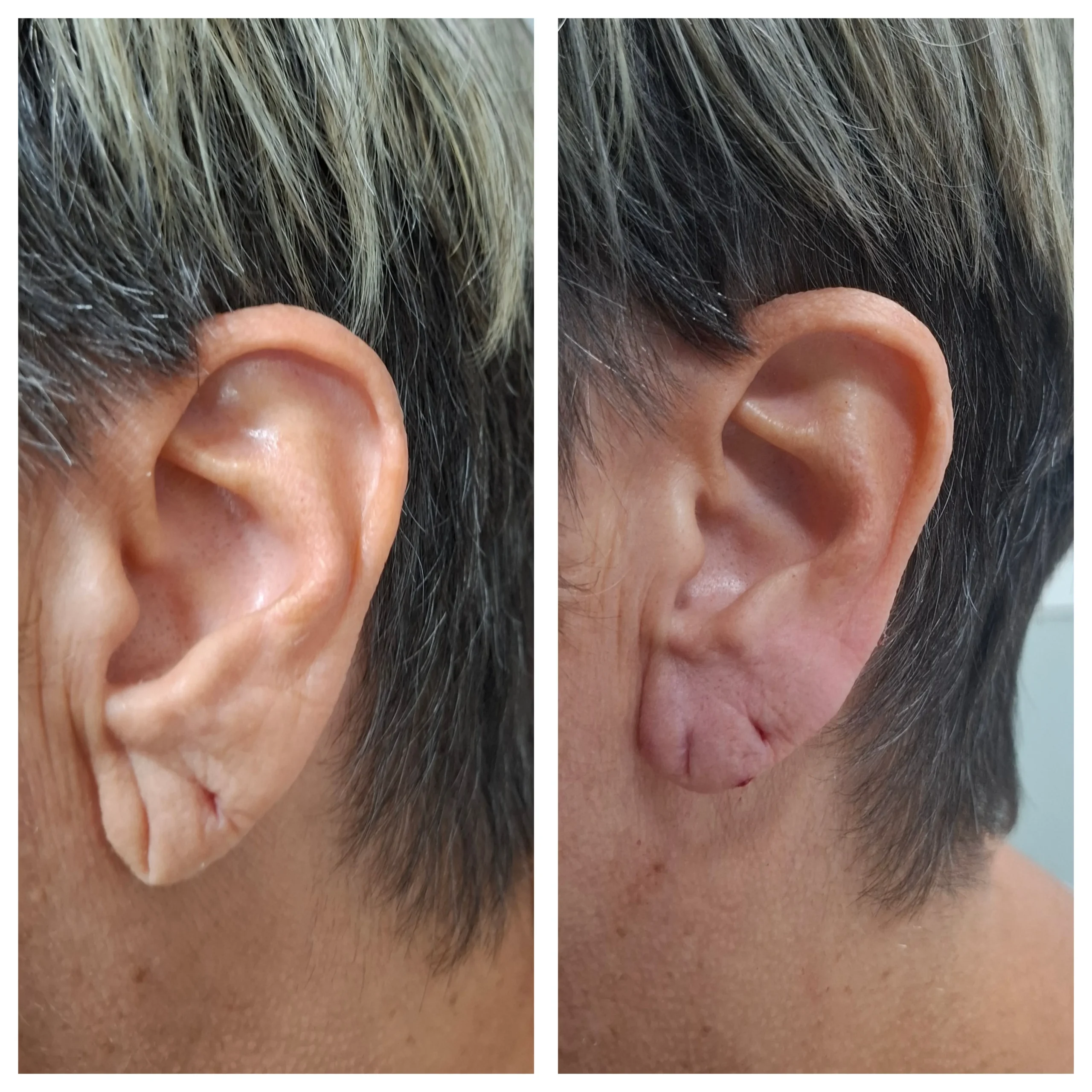 Antes e depois de preenchimento do lóbulo da orelha, resultado 2