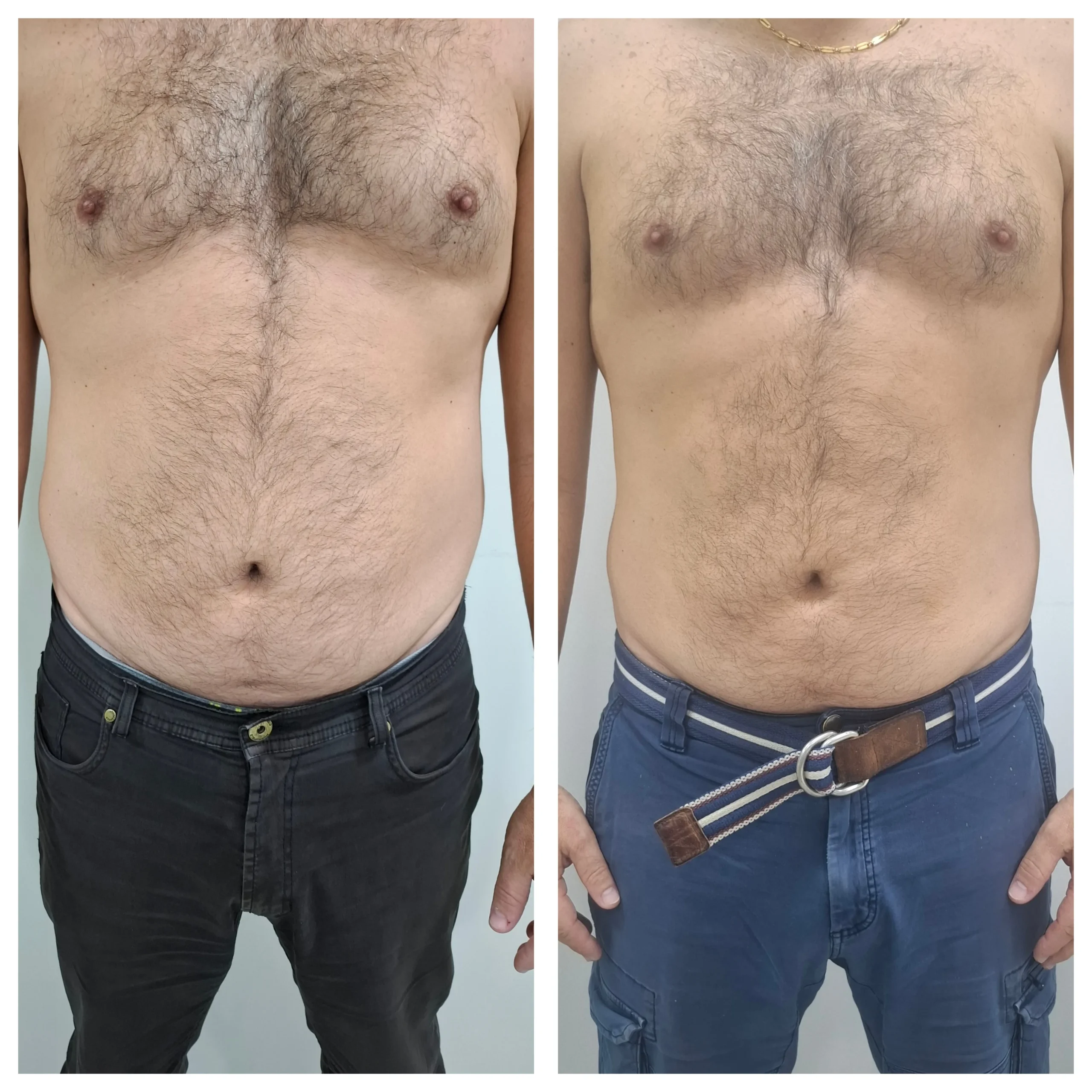 Antes e depois do protocolo gordura localizada, resultado 1