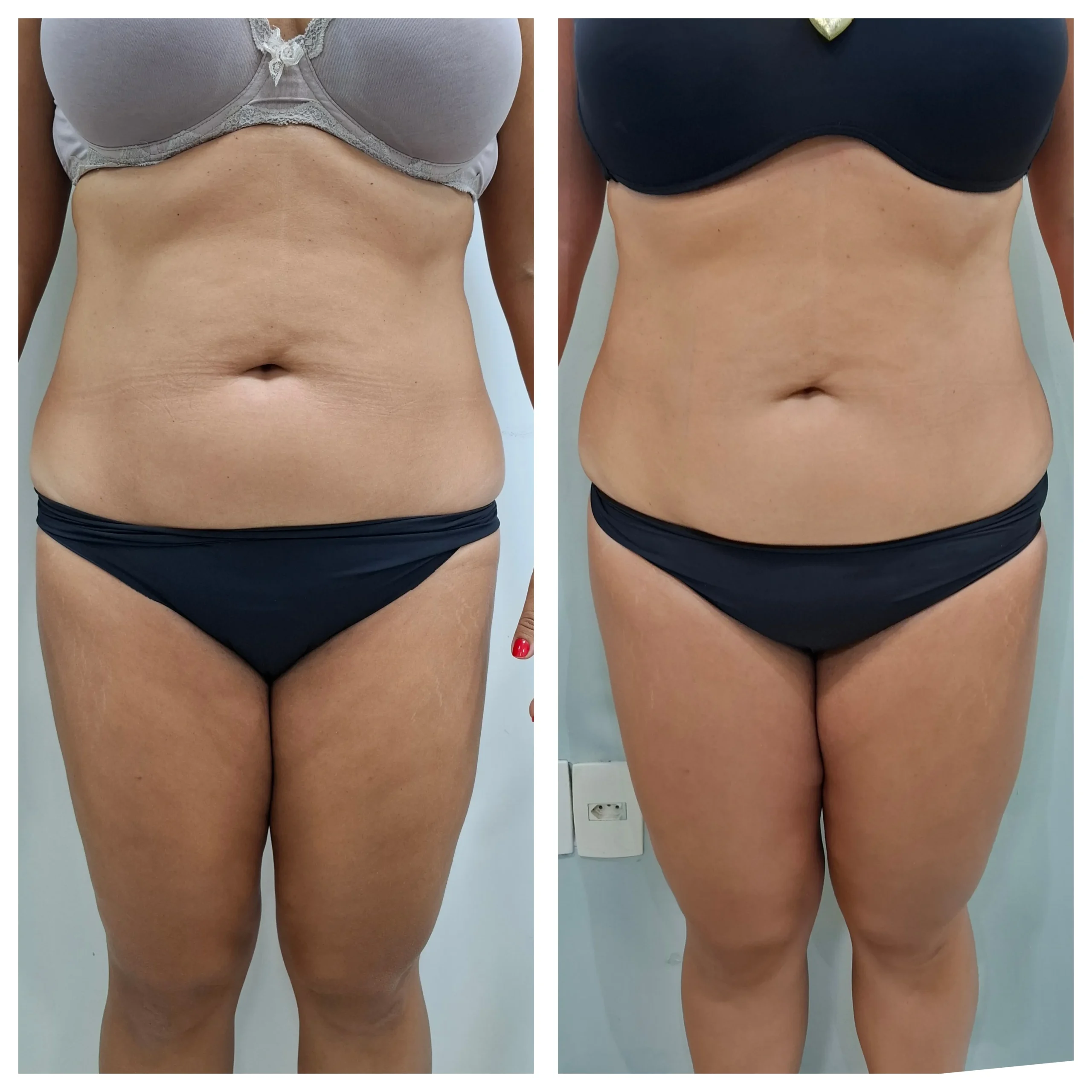 Antes e depois do protocolo gordura localizada, resultado 2