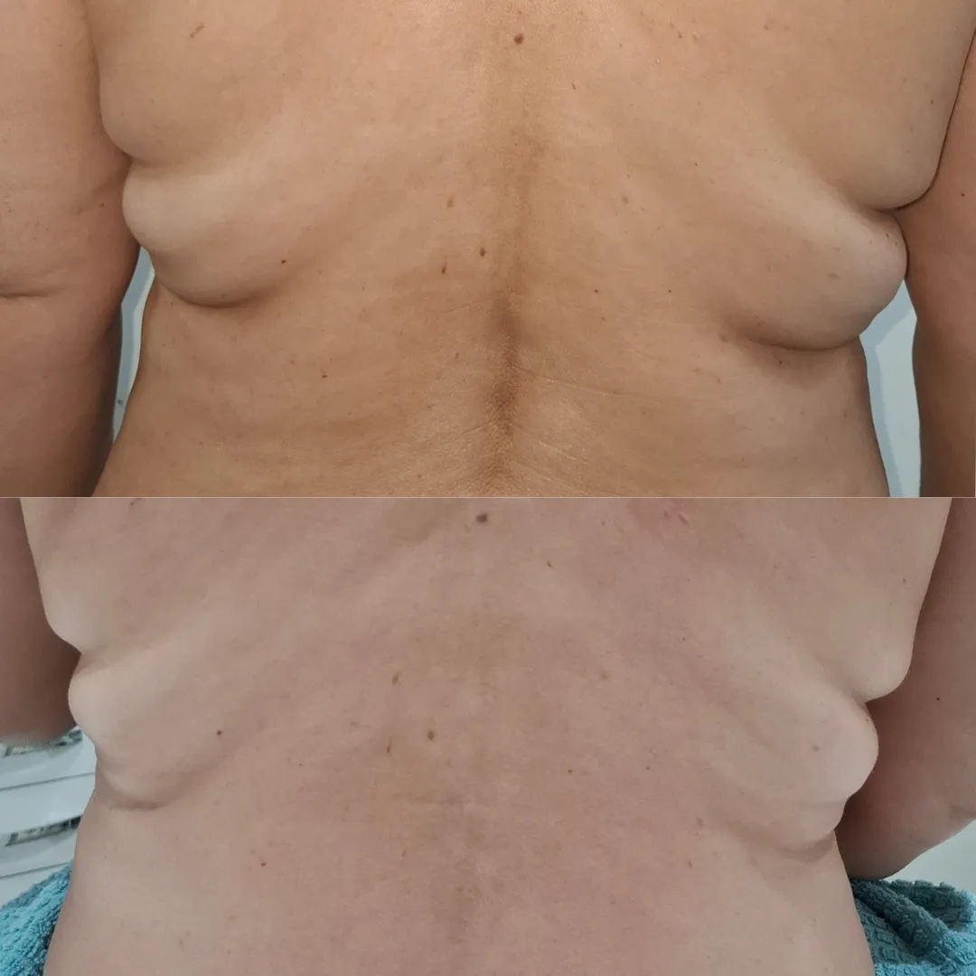 Antes e depois do protocolo gordura localizada, resultado 3