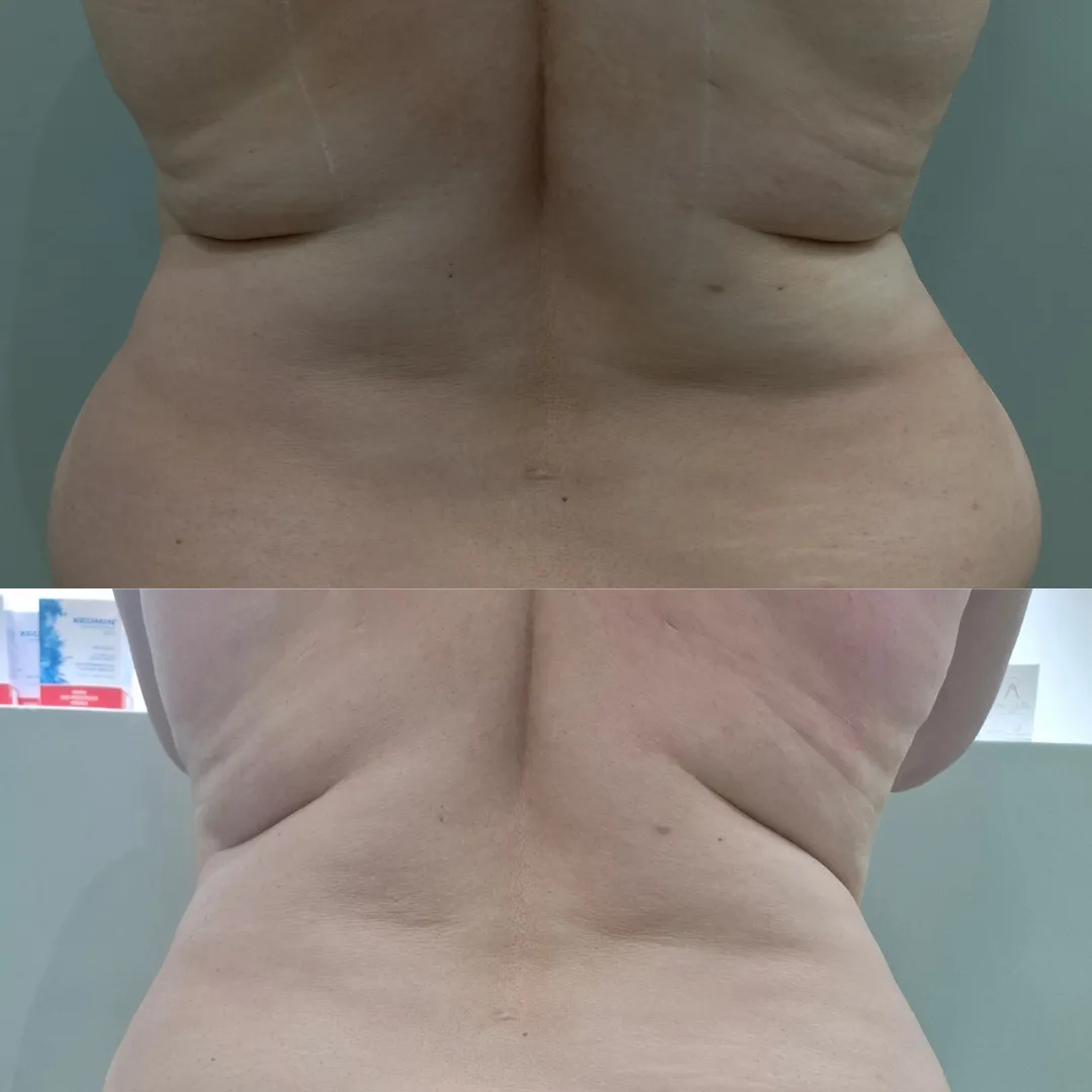Antes e depois do ultrassom microfocado corporal, resultado 1
