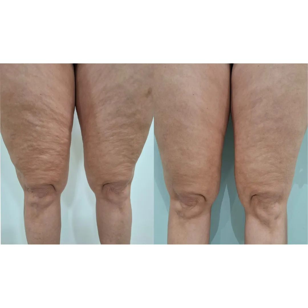 Antes e depois do ultrassom microfocado corporal, resultado 2