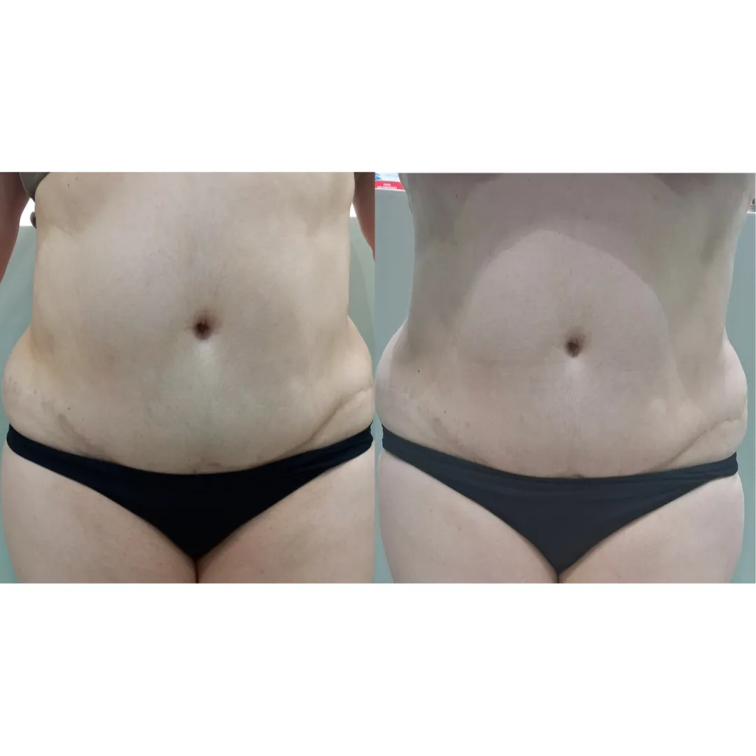 Antes e depois do ultrassom microfocado corporal, resultado 3